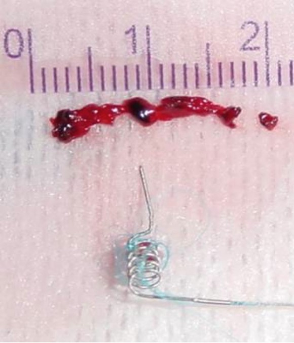 thrombus